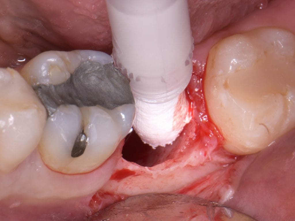 powerbone dental putty