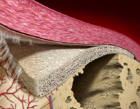dental membranes for GBR