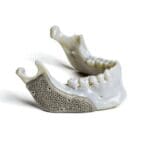 titanium-mesh-patient-specific-implant-attenborough-medical-landscape