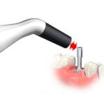 Penguin RFA implant stability coefficient
