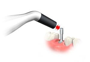 Penguin RFA implant stability coefficient