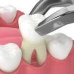 tooth out what next