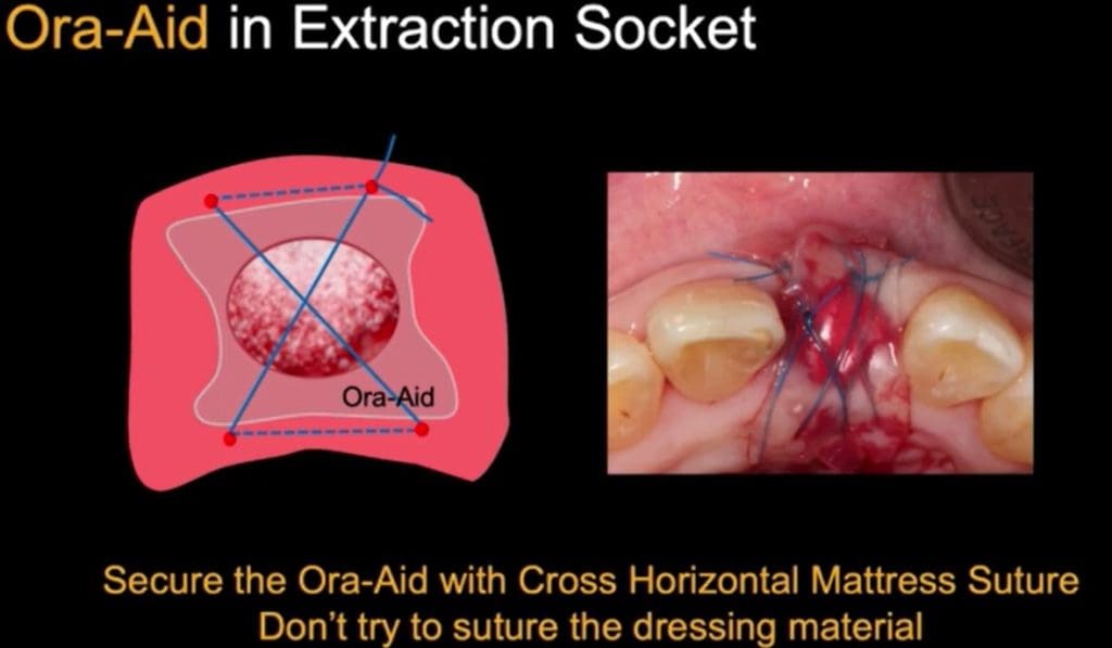 ora-aid socket sealing