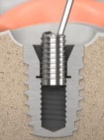 Broken Prosthetic Screw Retrieval Kit (Single option)