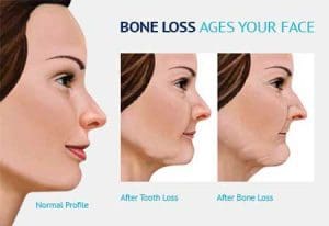 dental bone atrophy