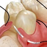 dental sutures at restore surgical